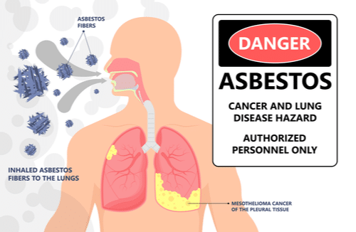 Asbestos-Related Lung Cancer Attorneys in Buffalo, Rochester and Syracuse, NY